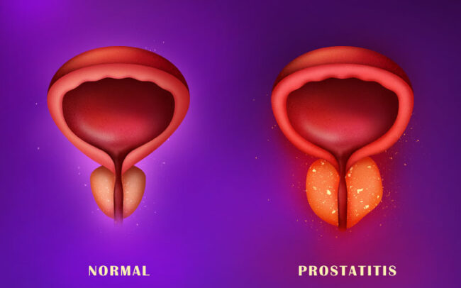 Chronic prostatitis treatment with bacteriophage therapy