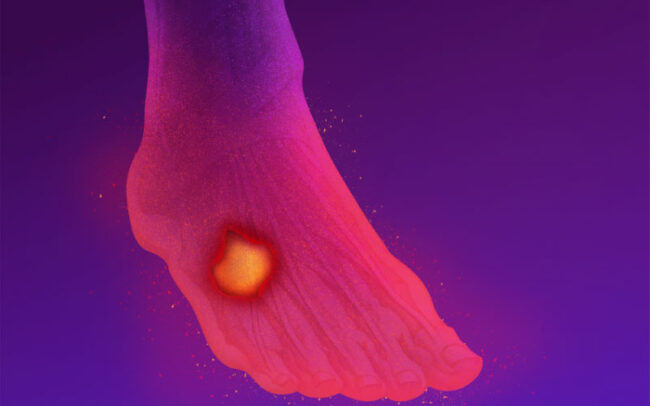 Diabetic foot infection treatment with phage therapy at Eliava Center